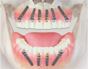 chart implant dentar