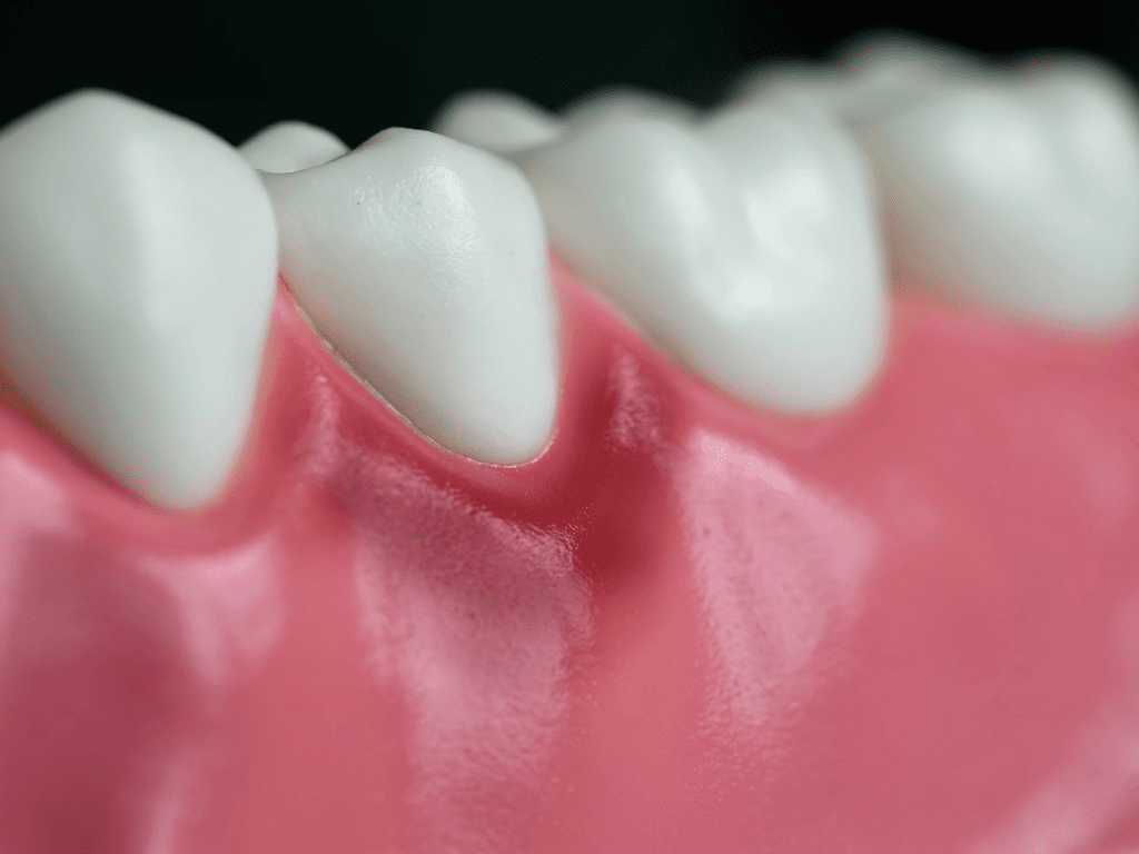 gingii inflamate care sangereaza in jurul unui dinte