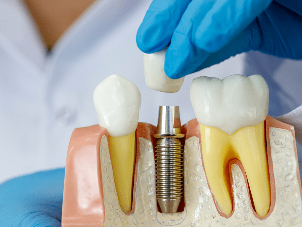 figurina explicativa pentru implant dentar si coroana