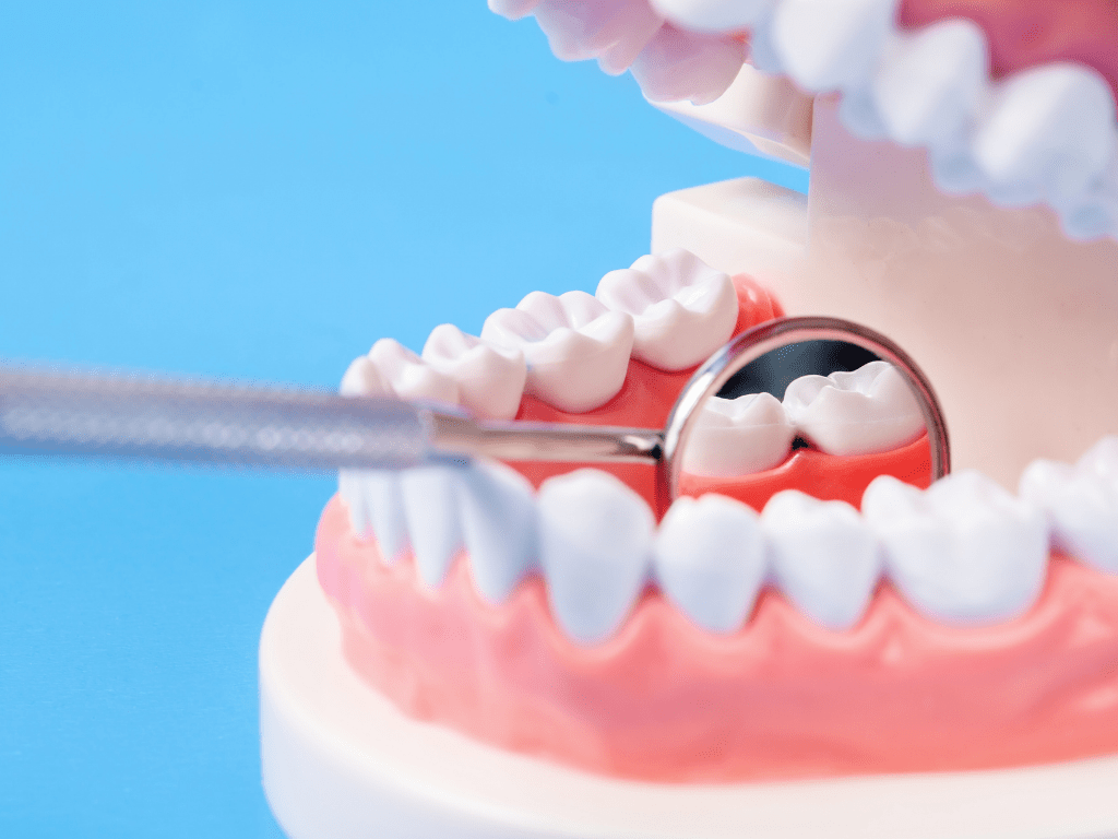 carie dentara amplasata intre dintii din spate