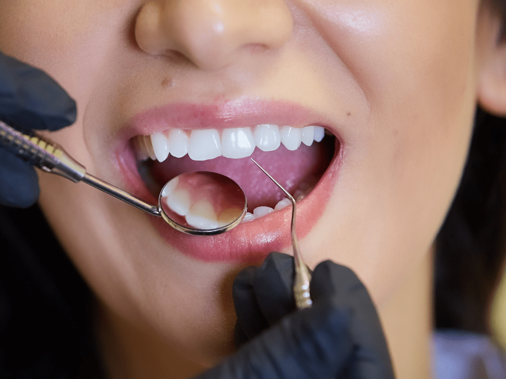 control stomatologic efectuat pentru aplicarea fatetelor dentare