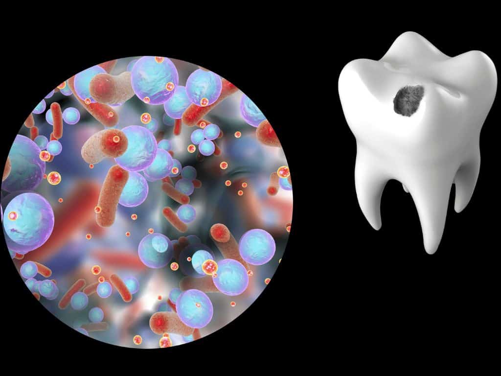 cum arata la microscop un dinte care este afectat de o carie