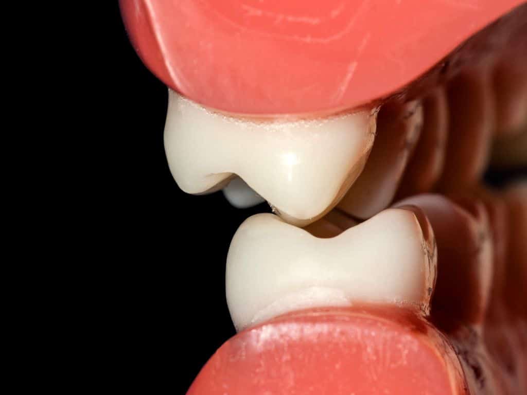 anomalie dentara ocluzie