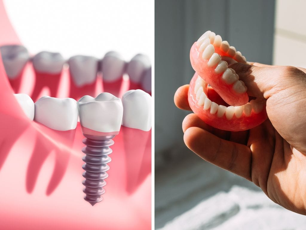 implant si proteza dentara