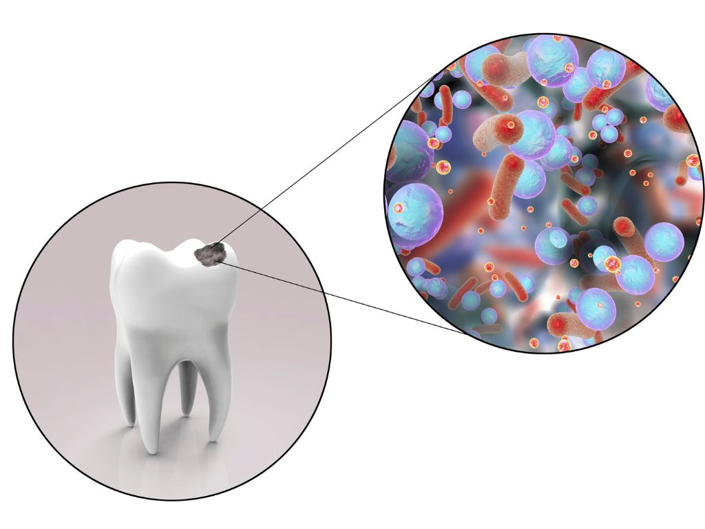 grafic cu dinte afectat de carii si zoom pe bacterii