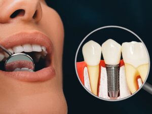 femeie la un control stomatologic dupa un implant dentar