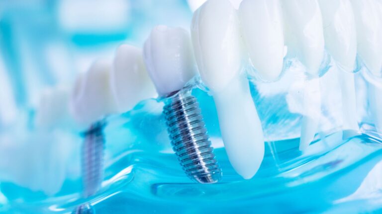 implant dentar bredent